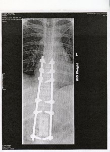 Front View of My Spine