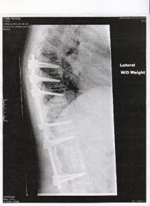 Side View of My Spine